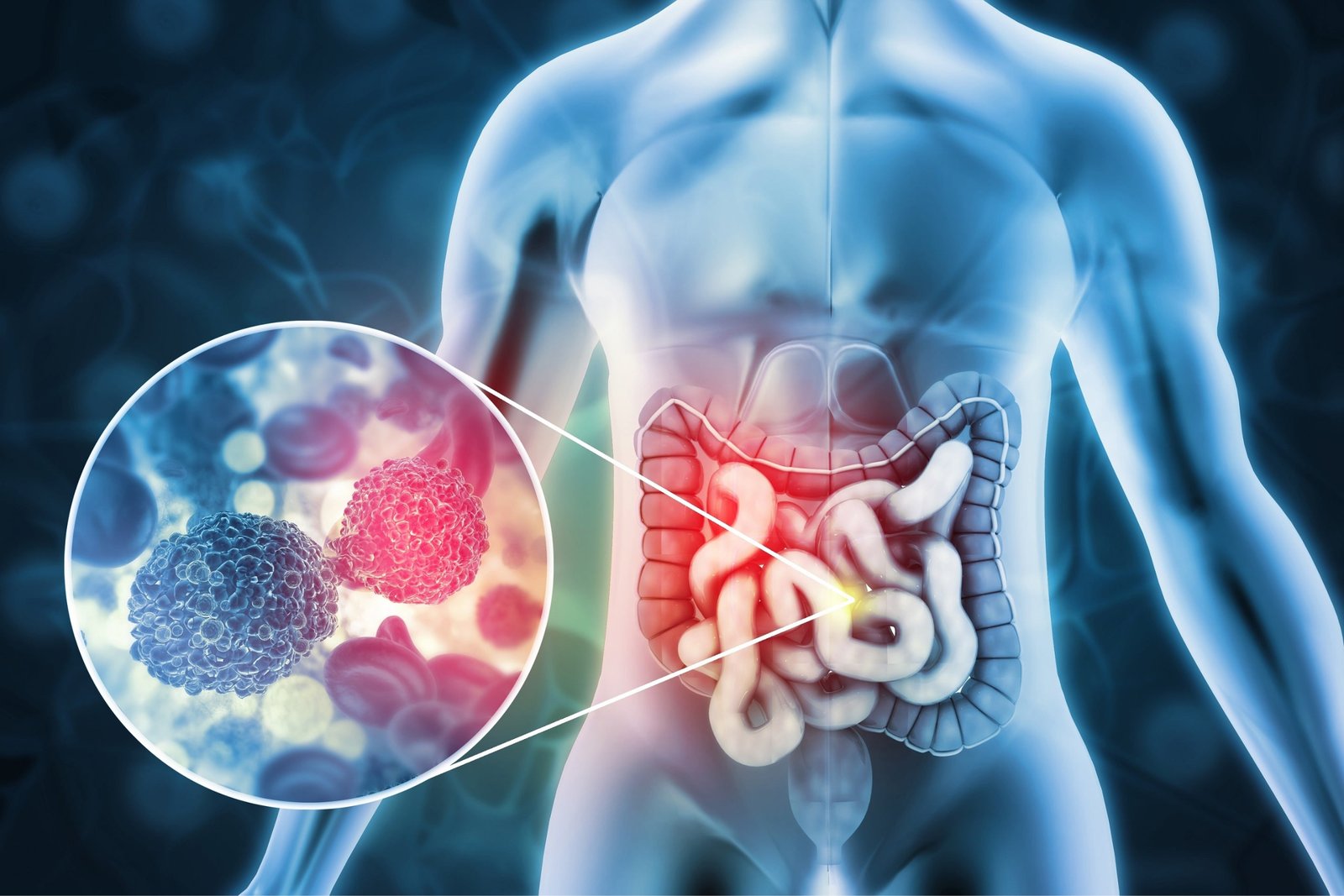 Colon Cancer
