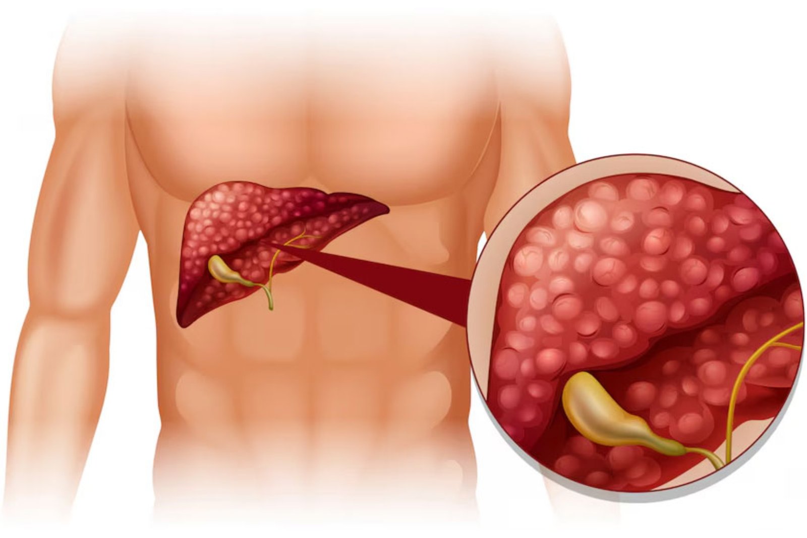 Gallbladder Cancer