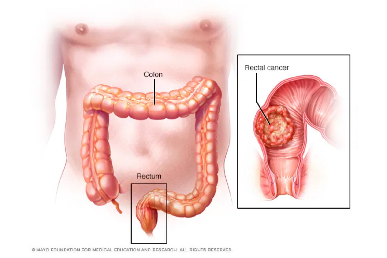 Rectal Cancer